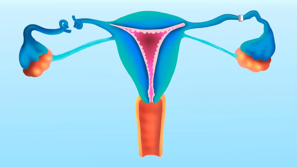 A cartoon drawing of the female reproductive system showing two types of tubal ligation.